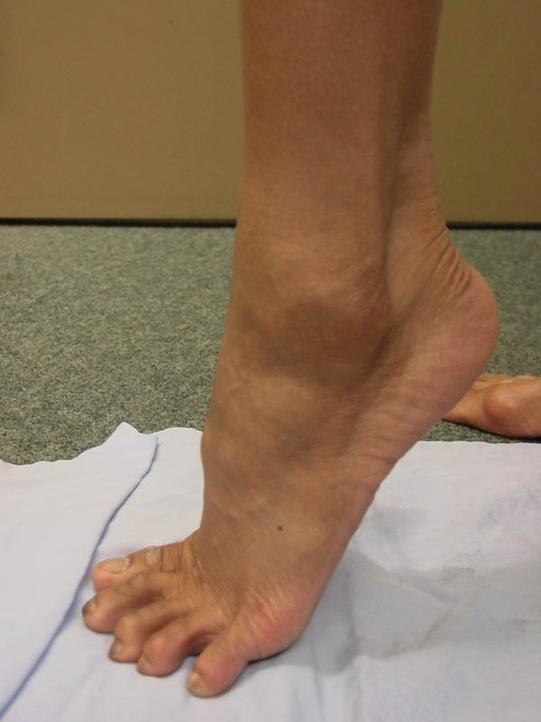 Peroneal Dislocation 2